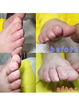 【肥厚・変形爪】ネイル/フット