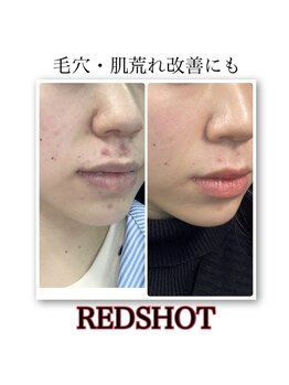 ルアナライフ(Luana Life)の写真/毛穴レス肌へ！たるみ毛穴・ニキビケアに集中。目の下・エラの脂肪もケアして若々しく♪