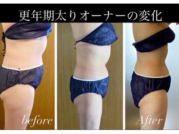 アリス 赤坂の写真/【鏡を見てふと気づく年齢による体型変化】/下腹の浮き輪や背中のハミ肉に上半身360度丸ごと痩身