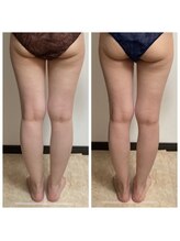 プリズミント(Prismint)/脂肪燃焼パック