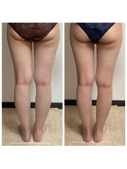 プリズミント(Prismint)/脂肪燃焼パック