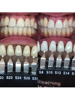 トウキョースワーズ 渋谷店(TOKYO SWRS)/#ホワイトニング #渋谷 #池袋