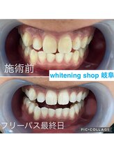 ホワイトニングショップ 岐阜駅前/#岐阜ホワイトニング#岐阜エステ