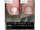 巻き爪ケア