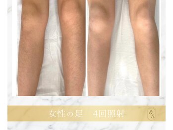 アンド エヌ(&n)/◆足美肌脱毛◆