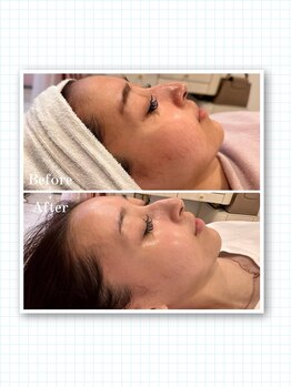 リリー(LILLY)/症例