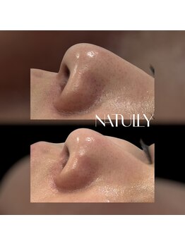 ナチュリー(Natully)/お客様ビフォーアフター