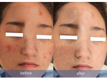 ハーシークレット(Her secret)/ダクトピール+毛穴洗浄