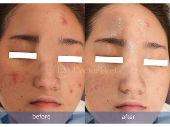 ハーシークレット(Her secret)/ダクトピール+毛穴洗浄