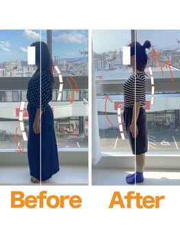 整体院ひなた 宮崎院/結婚式までに反り腰猫背改善!!