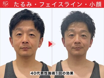 顔ジム 麻布十番店/40代　気になる部位もスッキリ