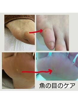 ドクターネイル爪革命 江戸川橋店/小指の魚の目って小さくても痛い