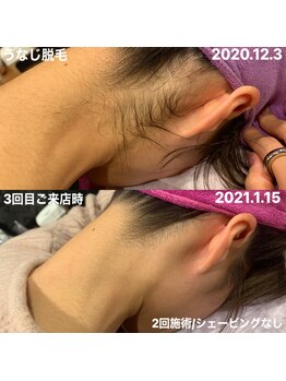 アンリミット(Unlimit)/お痛みが少なく効果◎な脱毛機♪