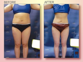 ジュリア オージェ 京橋店/ビフォーアフター(脂肪燃焼)