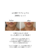 オルネ(ORNE.)/小顔フラクショナル