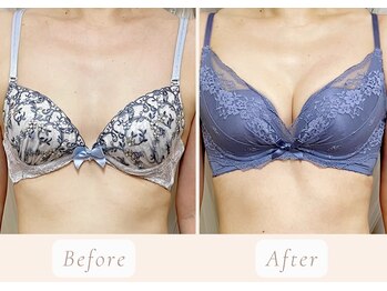 ノルン(Norn)/40代育乳バストケア（6回目）