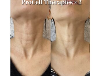 月香館/プロセルセ肌質改善