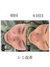 【20~30代始める！シミ改善コース人気】美肌ハーブピーリング