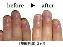 リング ザ ベル(ring the bell)/メンズ深爪コース¥12,100