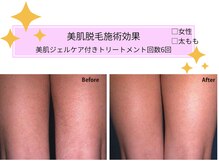 ヴィキ 北千住(VIKI)/【美肌脱毛】太ももbefore/After