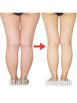 スリムビューティー 立川店/4機器脂肪分解脚スッキリ美脚へ