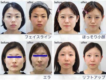 美デザイン 大宮店(美.design)/☆小顔矯正Before-After