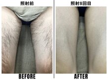 ストック 立花店(STOCK)/【全身】太もも照射前→8回