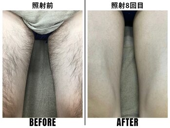 ストック 立花店(STOCK)/【全身】太もも照射前→8回