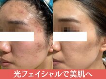 サロン ド ミュゲの雰囲気（光フェイシャルで肌質管理♪通うほどに赤みも薄く♪）