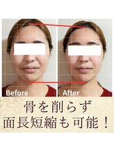 スウ(suu.)/Before-After【30代】1回