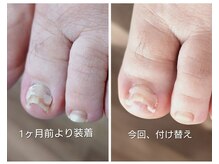 アンティ(Aunty)/巻き爪補正