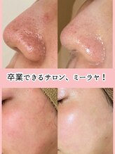 ミーラヤ(MILAYA) お肌状態で 施術提案