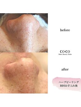 ココセンガビューティークリニック 恵比寿(COCO SENGA Beauty-Clinic)/ハーブピーリング★before/after