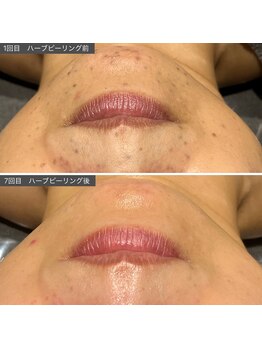 ロッタ エクリュ(Lotta ecru+)/REVI剥けないハーブピーリング