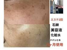 ブルーバケーション(Blue Vacation)の雰囲気(エステ数回 スキンケア2ヶ月使用)