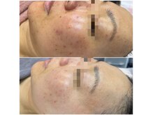 マルカ(MARUKA)の雰囲気(1回目のビフォーアフター!ニキビケア肌育ハーブピーリング)