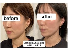 グリーン鍼灸整体院(green鍼灸整体院)/美容鍼