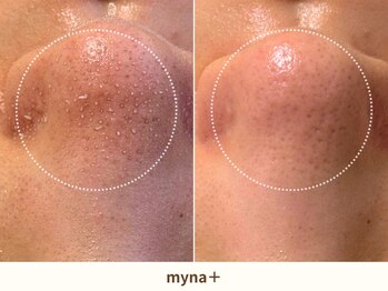 マイナプラ 表参道(myna+)/3STEPハイドラ毛穴洗浄