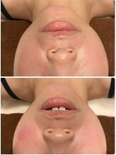 【美容整体×小顔矯正】Lilria/【歪み/フェイスライン】30代