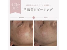 サロンドペシェ(salon de peche)/40代/美白乳酸ピーリング4回