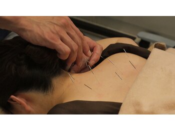 リリーフ治療院(Relief治療院)/首肩の鍼