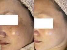 ポモナ 横浜馬車道店(Pomona)/手強いシミも解決◎