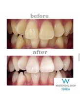 ホワイトニングショップ 宮崎店/【光の当て方調整します】