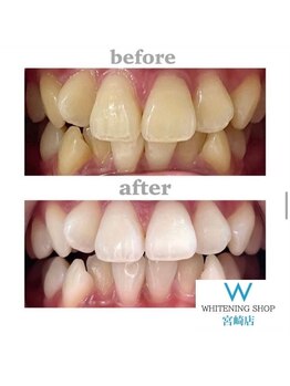 ホワイトニングショップ 宮崎店/【光の当て方調整します】