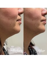 ホルバール 佐賀店(Hallbar)/小顔リフトアップマシーン