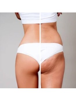 リラージェ 中目黒(Relaje)/*セル脂肪や美脚に○*