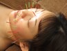 お化粧したままでOK!サクッと受けたい方はこちら【美容鍼】standardコース