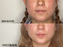 はりと美容鍼灸治療院(HaRi&美容鍼灸治療院)の雰囲気（継続することでシャープなフェイスラインと艶やかで明るい肌へ！）