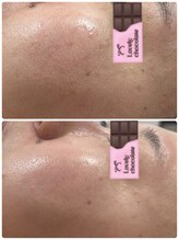 アルカンジュ(Archange)/ハイドロピーリング＋しみケア