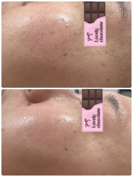 アルカンジュ(Archange)/ハイドロピーリング+しみケア